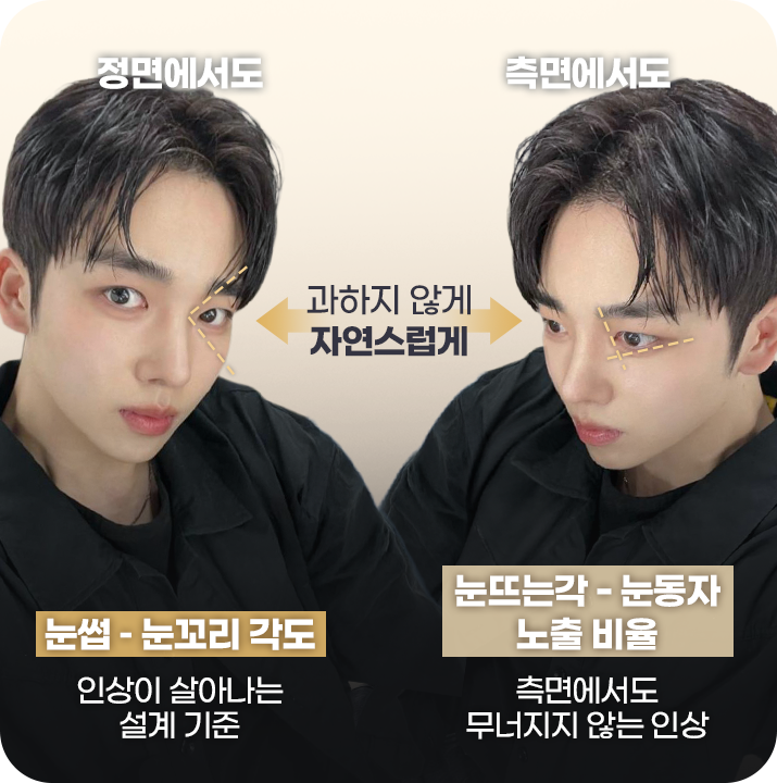 눈매교정 정리된 인상