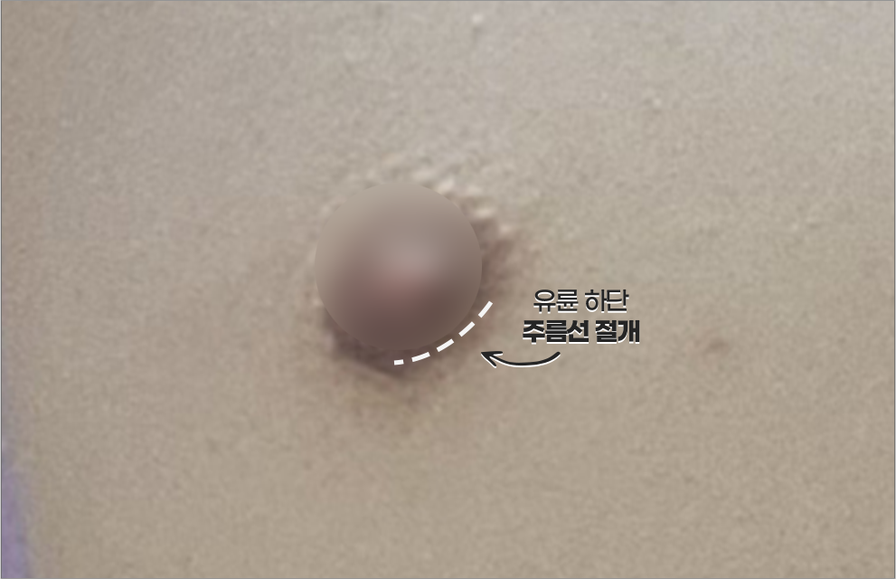 여유증 전후 케이스