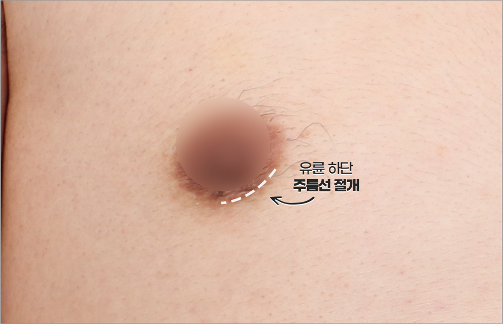 여유증 전후 케이스