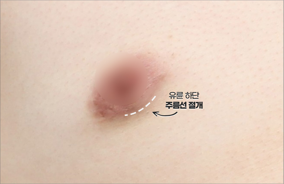 여유증 전후 케이스