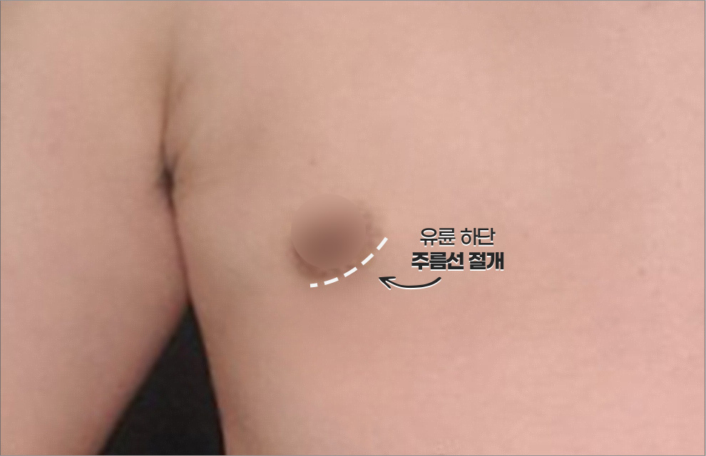 여유증 전후 케이스