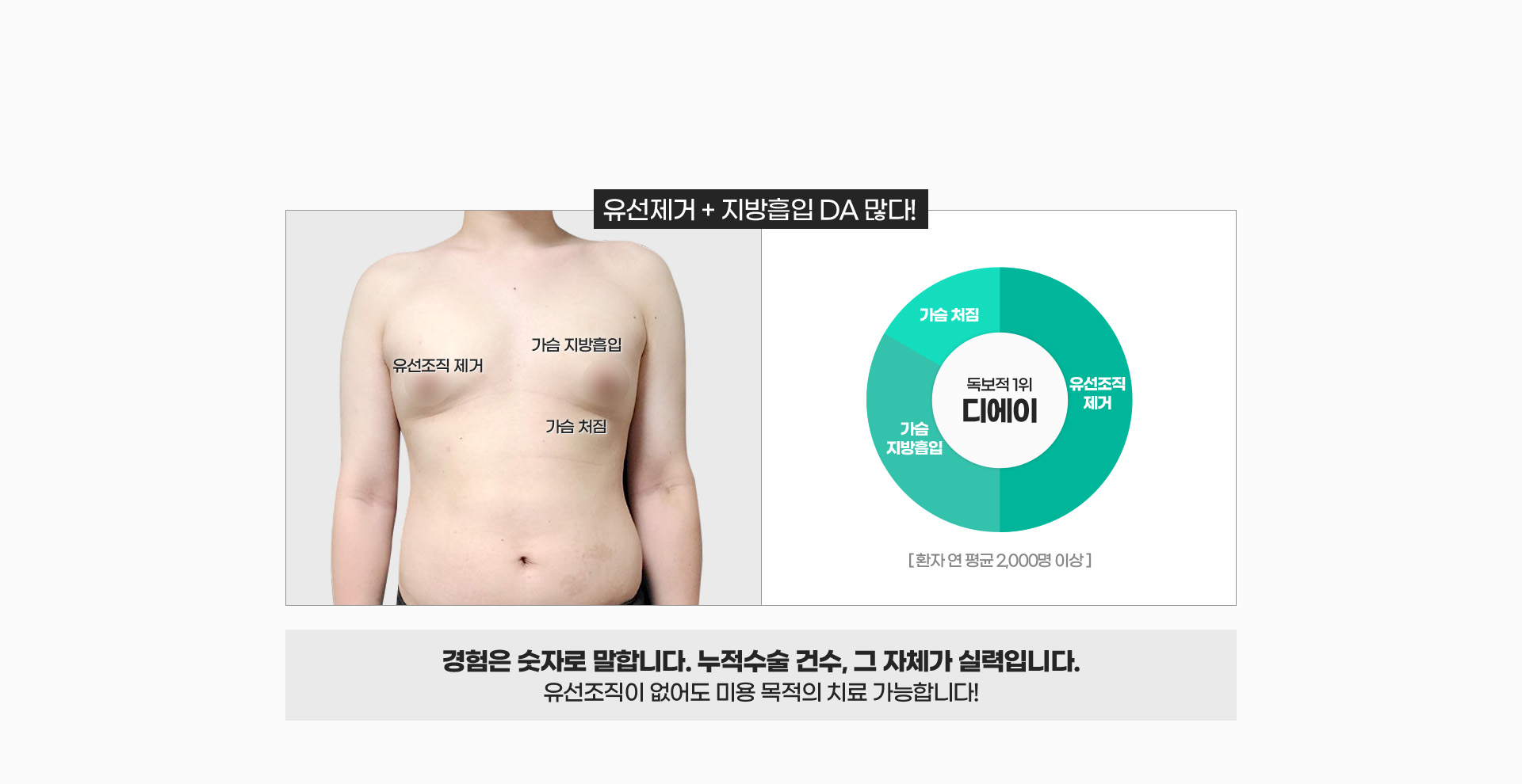압도적으로 많은, 여유증수술 건수