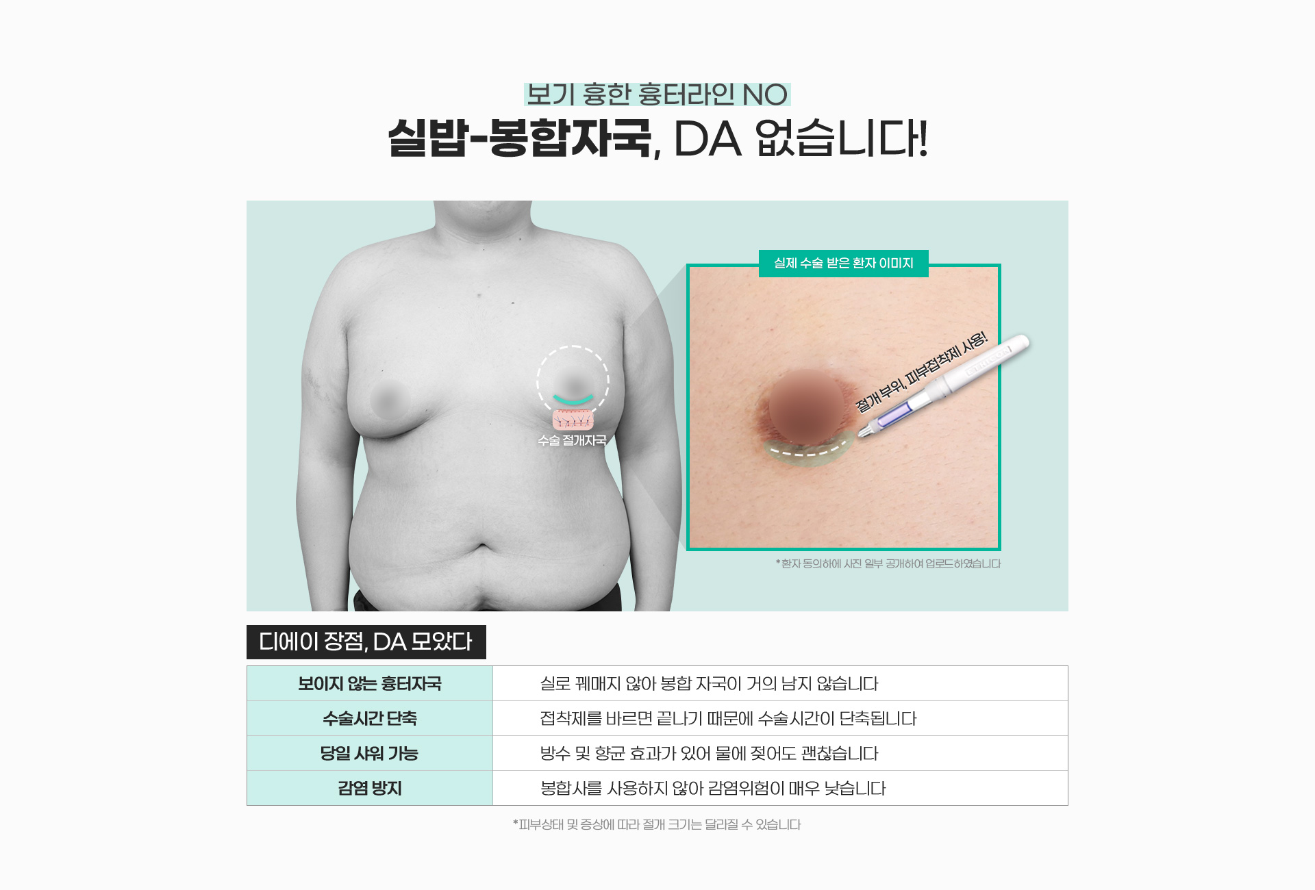 보기 흉한 흉터라인 NO 실밥 / 봉합자국, DA 없습니다!