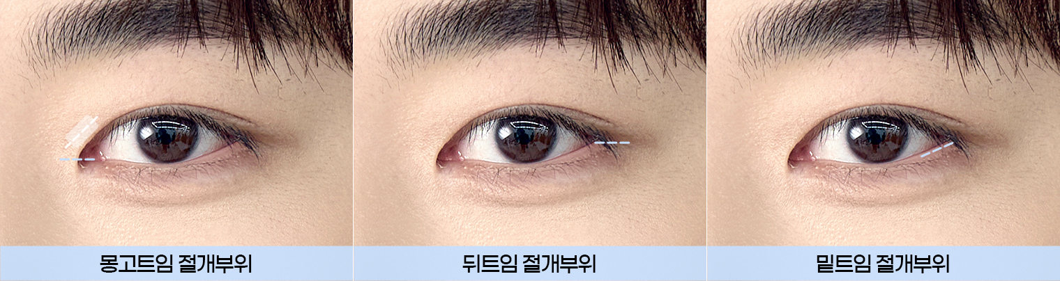 DA 남자 트임성형