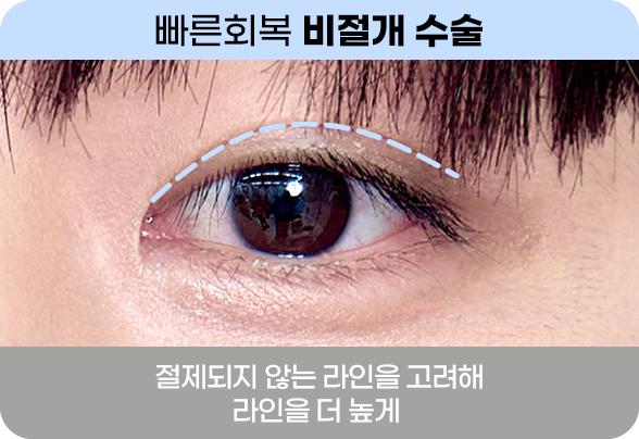 DA 남자 눈성형